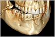Reabilitação estética após fratura mandibular unilateral e perda